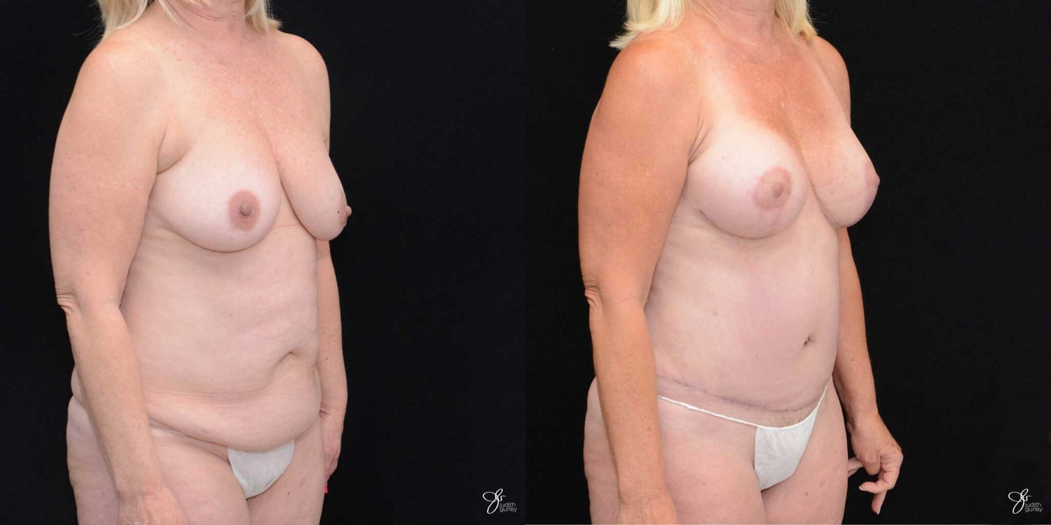 Mommy Makeover Before & After