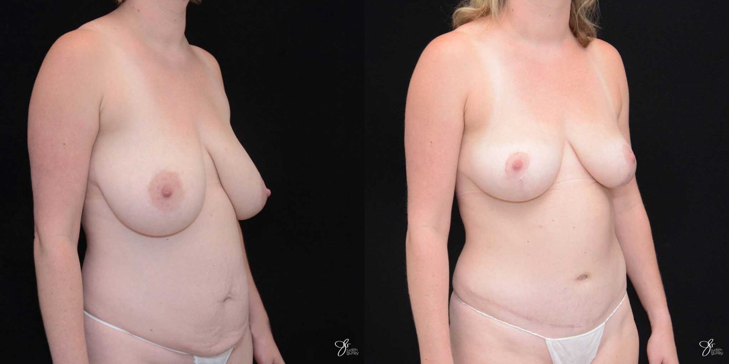 Mommy Makeover Before & After