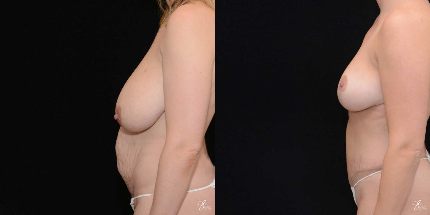 Mommy Makeover Before & After