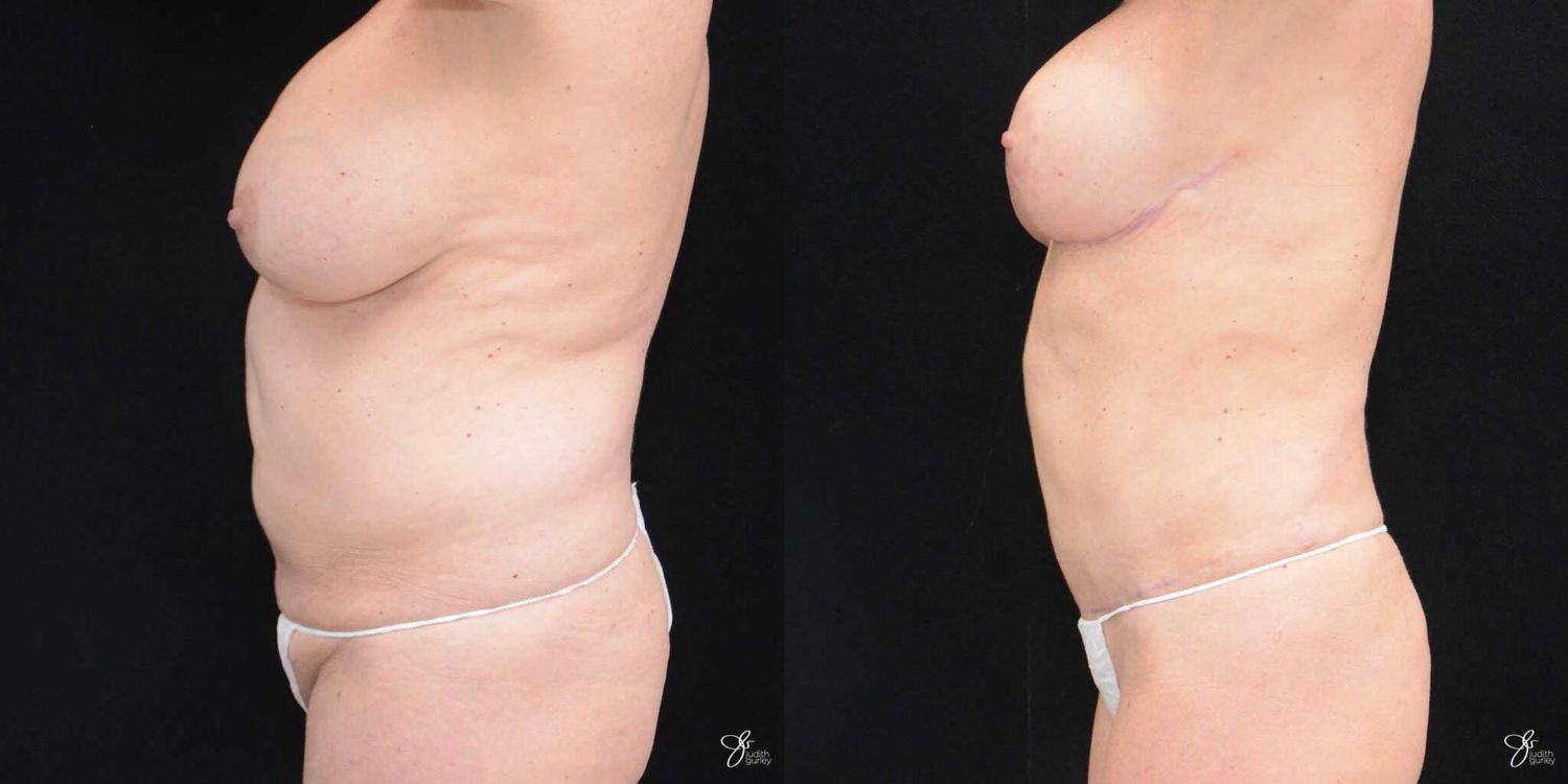 Mommy Makeover Before & After