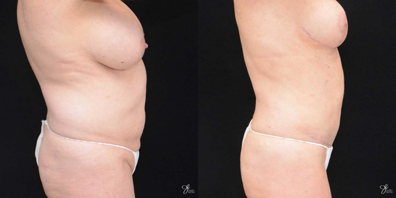 Mommy Makeover Before & After