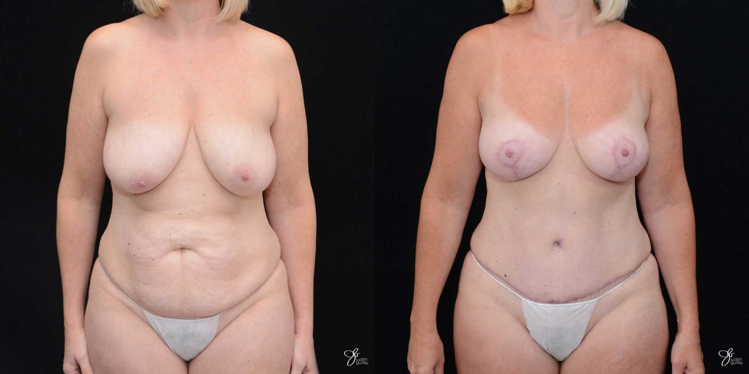 Mommy Makeover Before & After