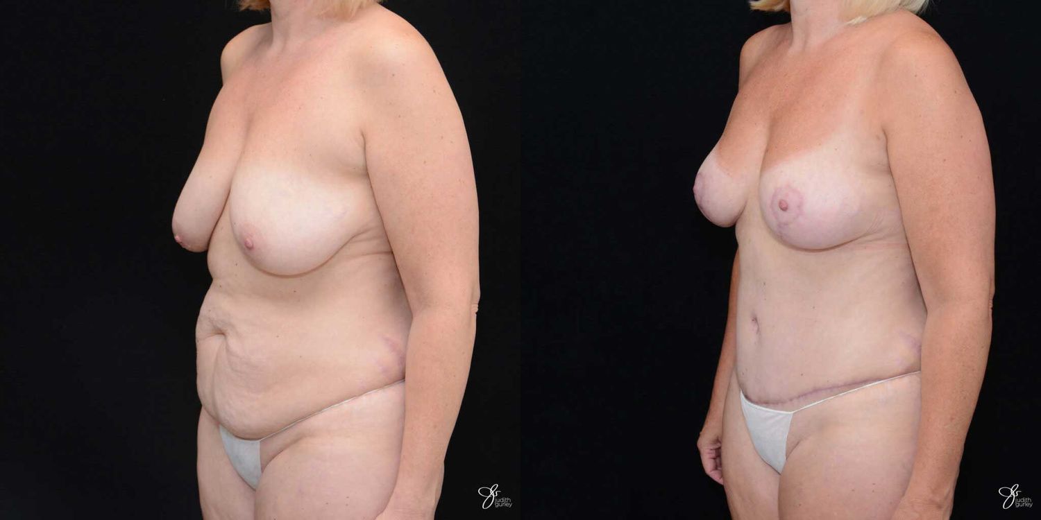 Mommy Makeover Before & After