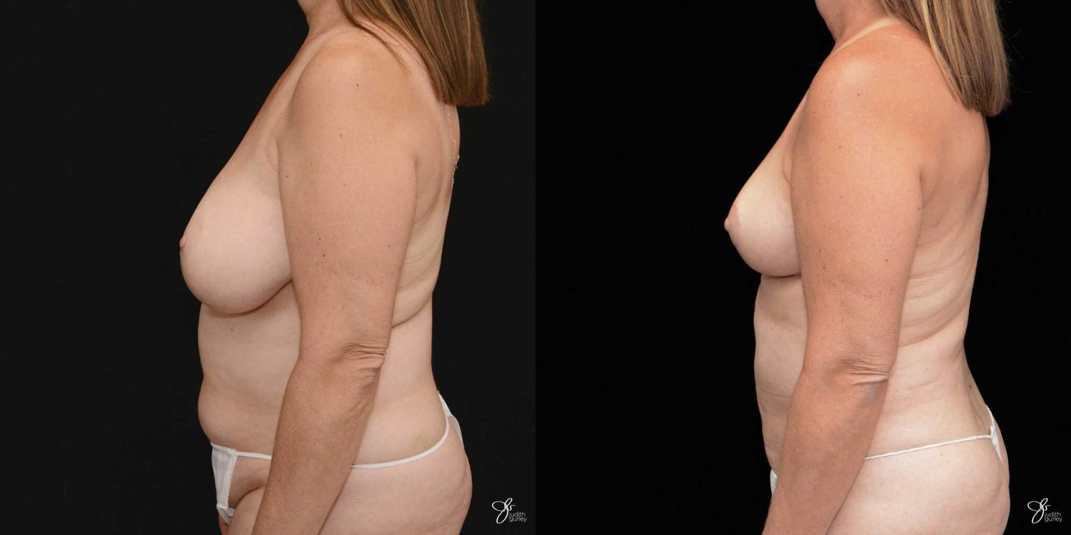 Mommy Makeover Before & After