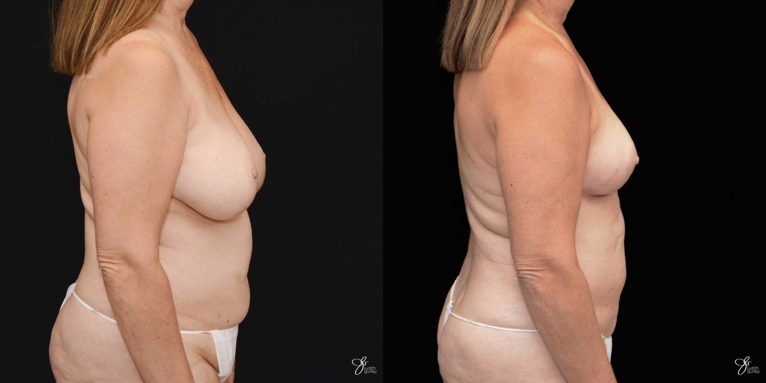 Mommy Makeover Before & After