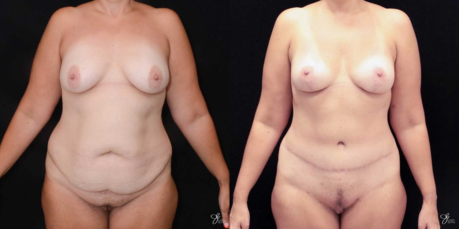 Mommy Makeover Before & After