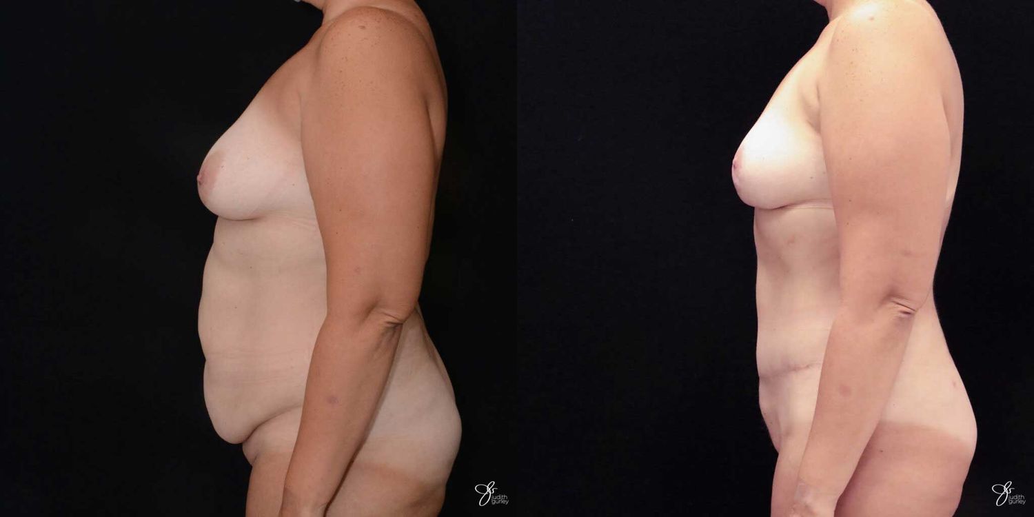 Mommy Makeover Before & After