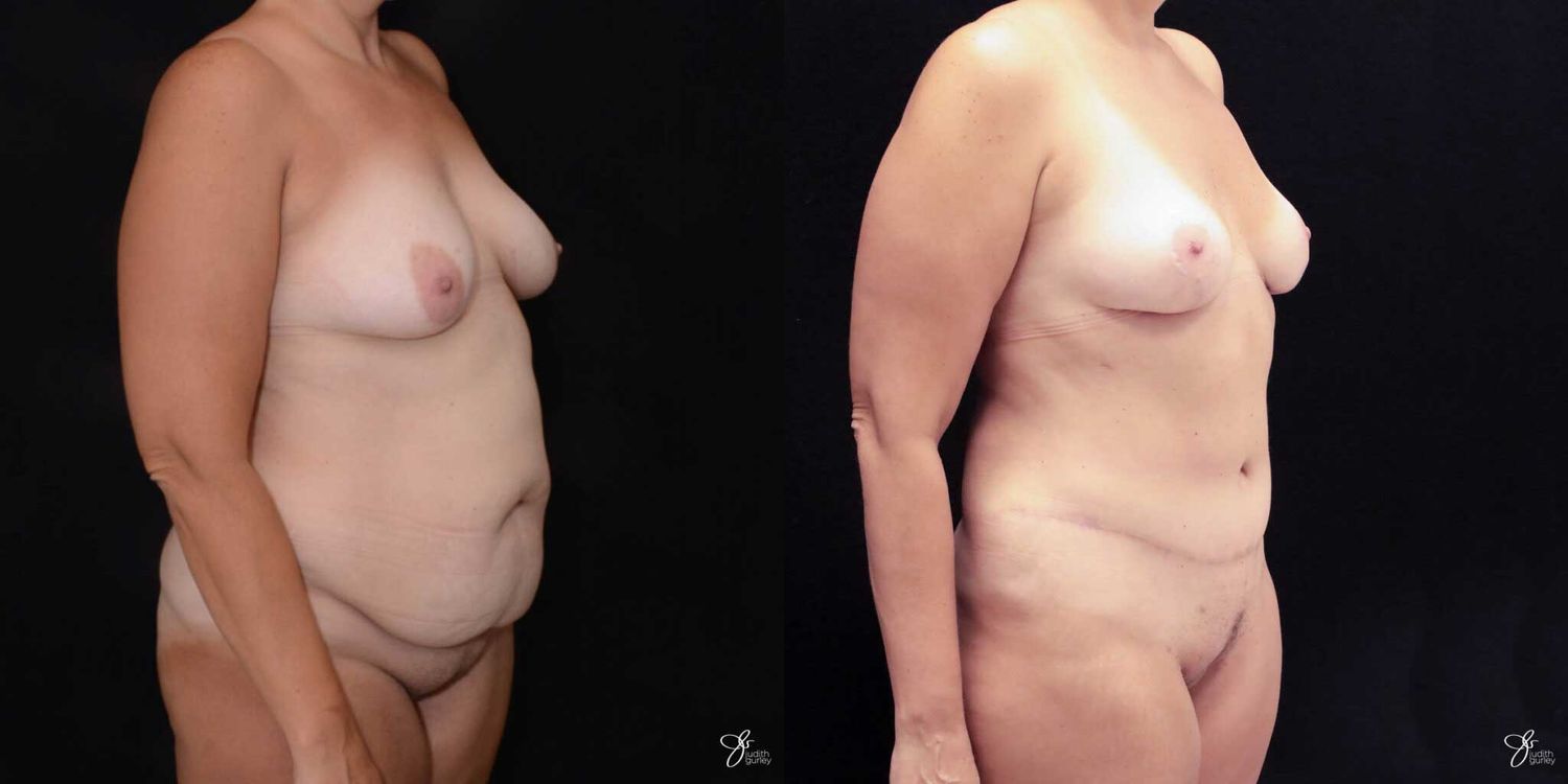 Mommy Makeover Before & After