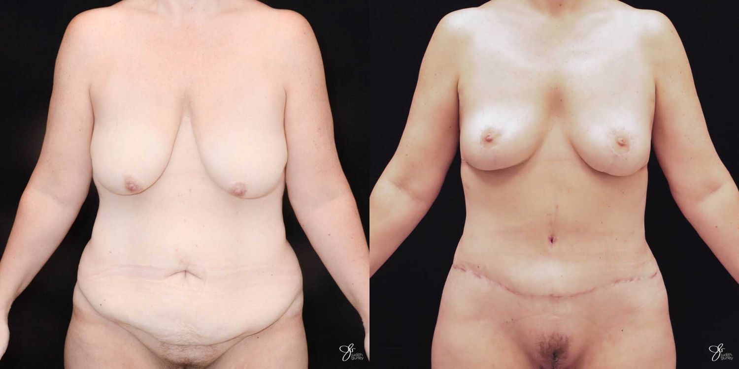 Mommy Makeover Before & After