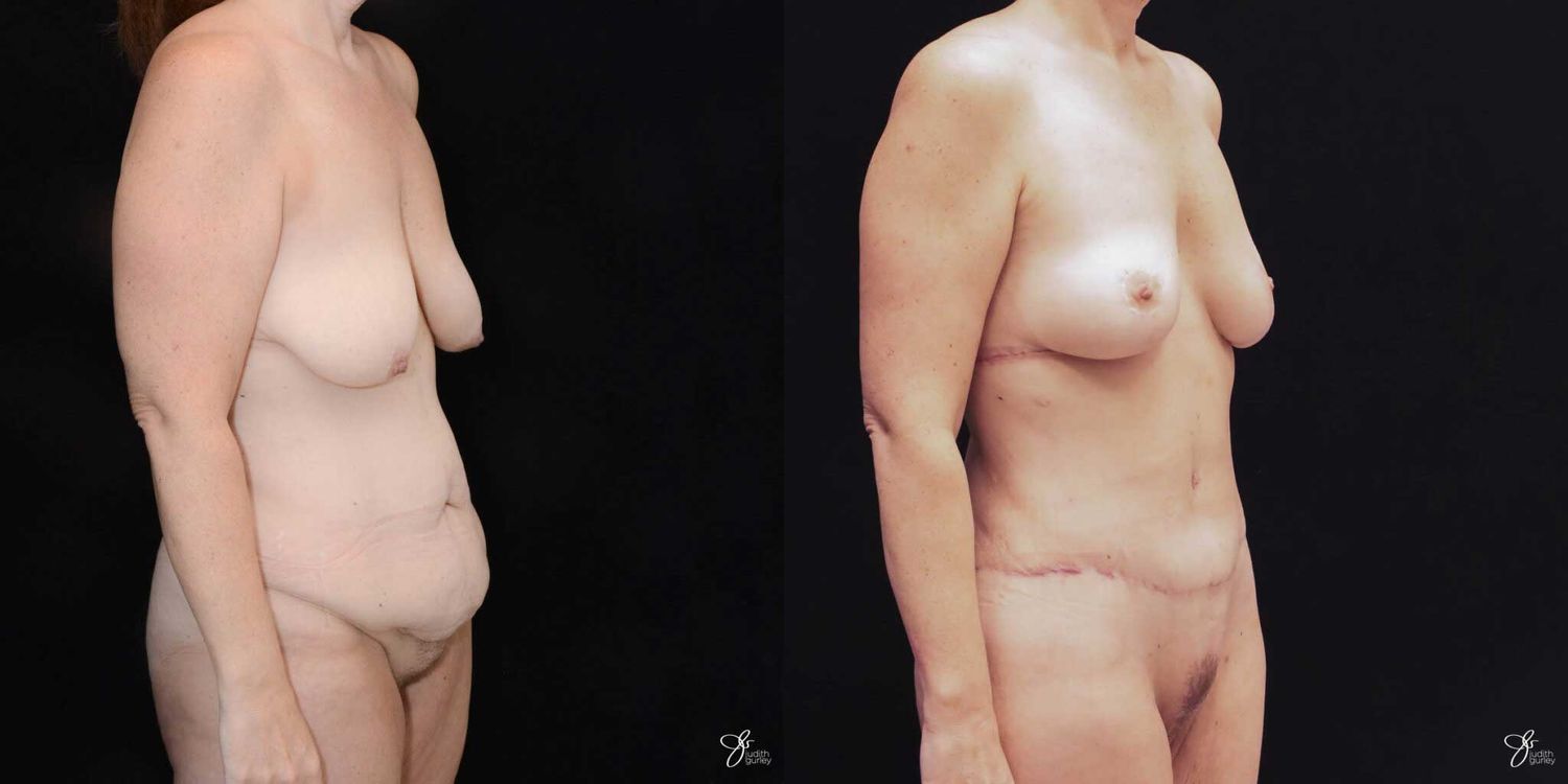 Mommy Makeover Before & After