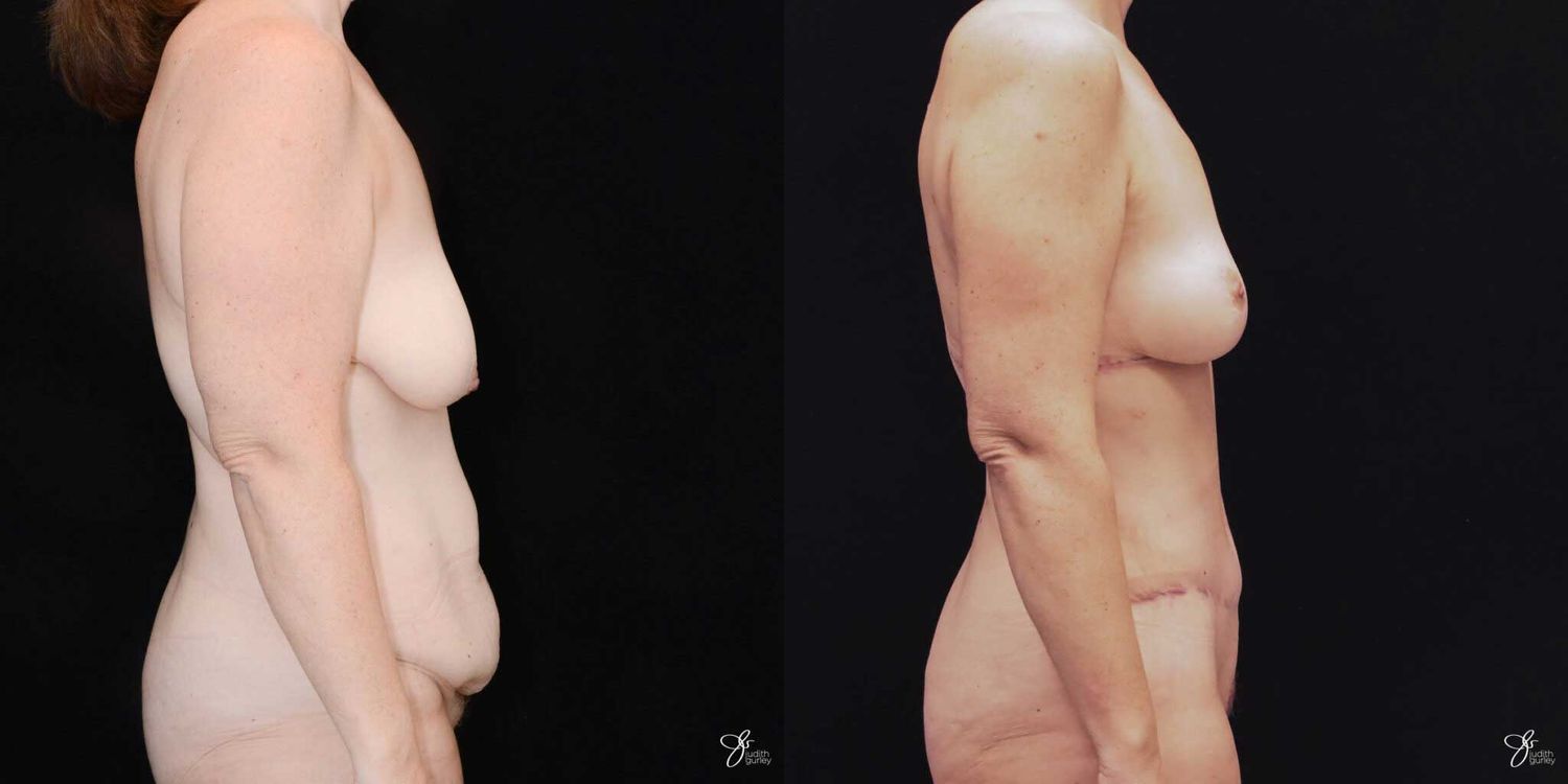 Mommy Makeover Before & After