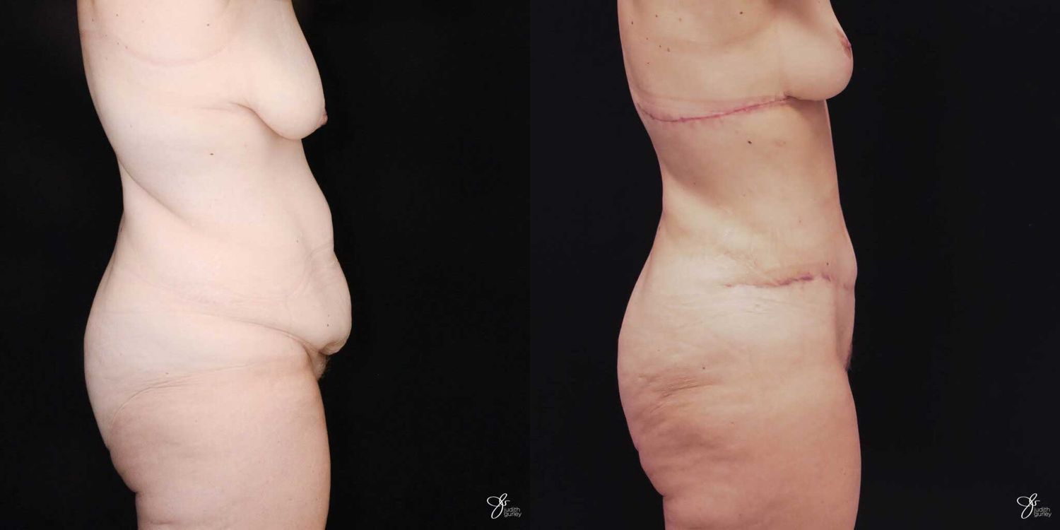 Mommy Makeover Before & After