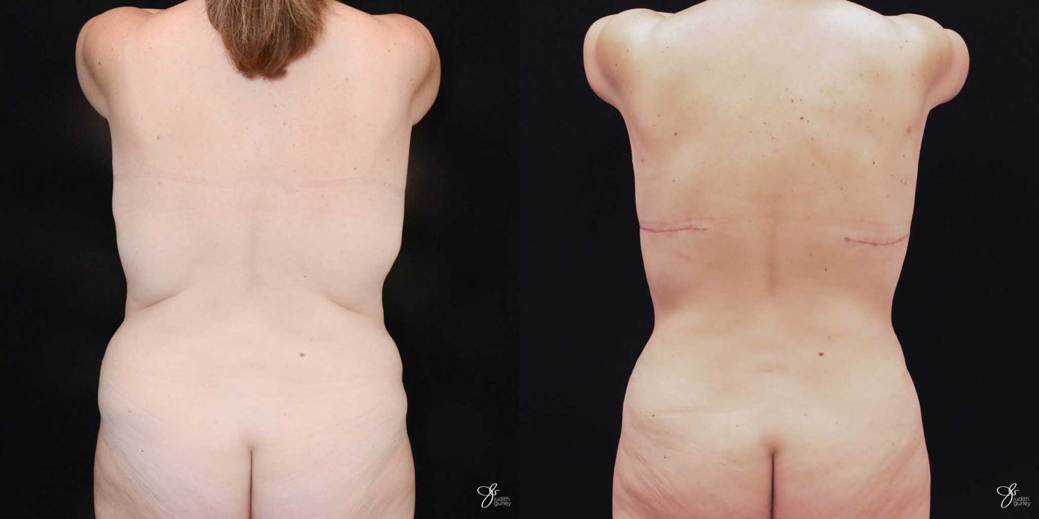 Mommy Makeover Before & After