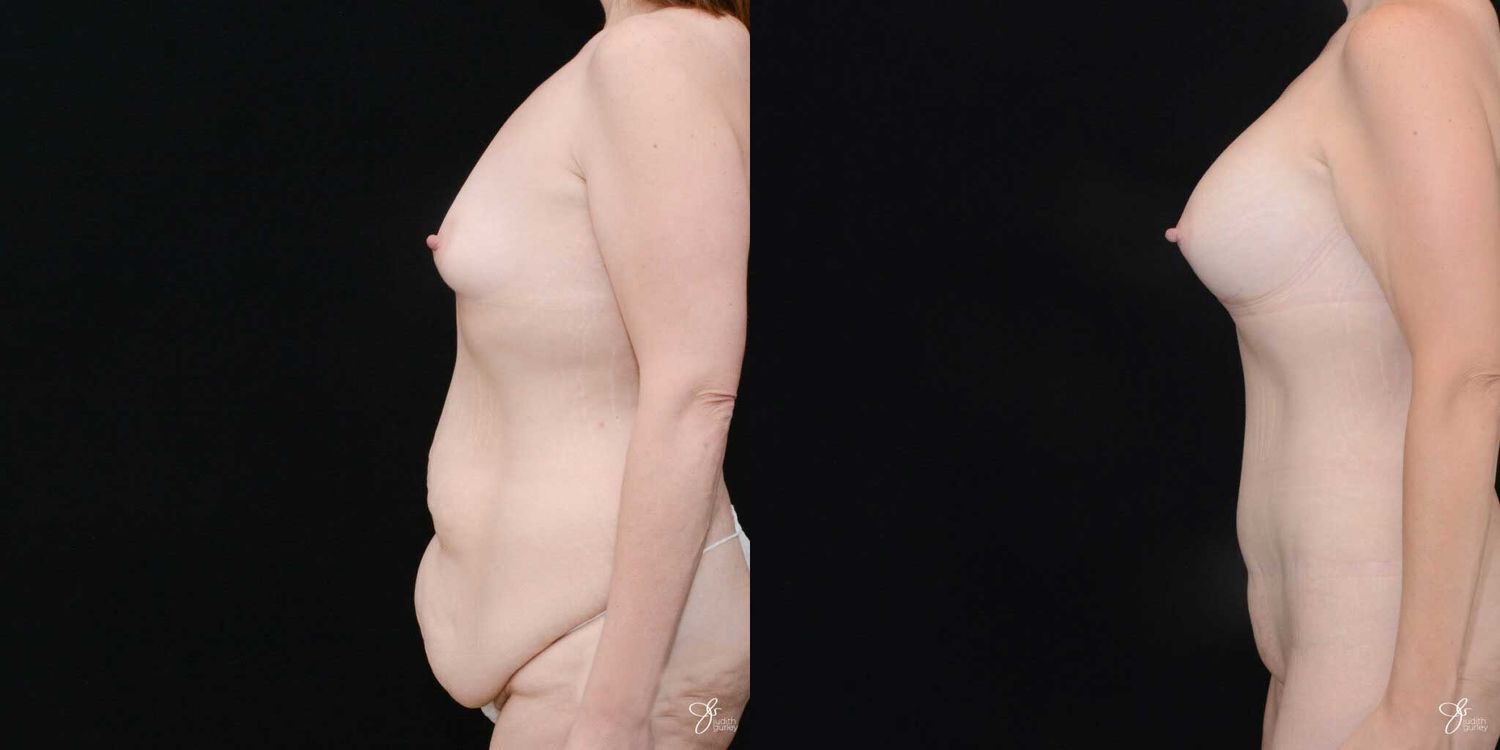 Mommy Makeover Before & After