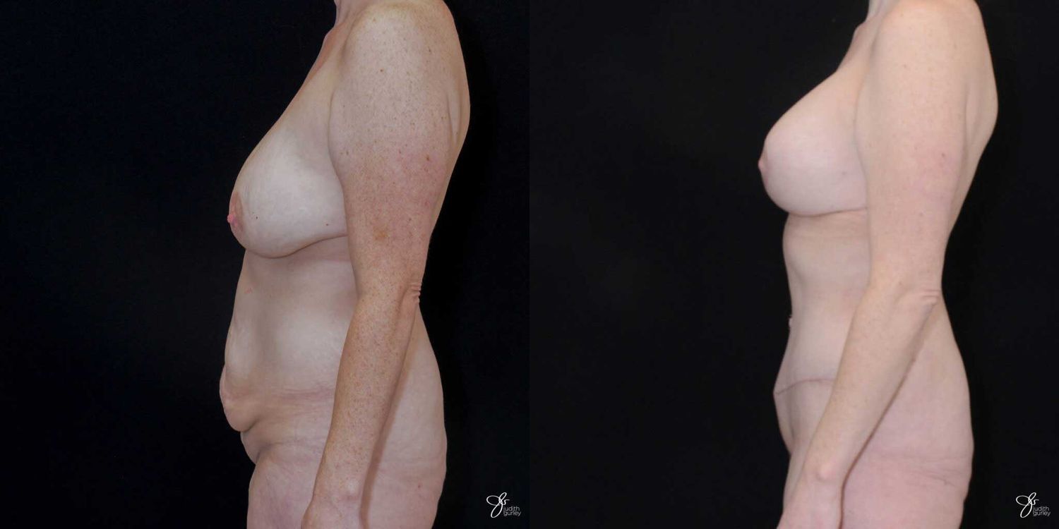 Mommy Makeover Before & After