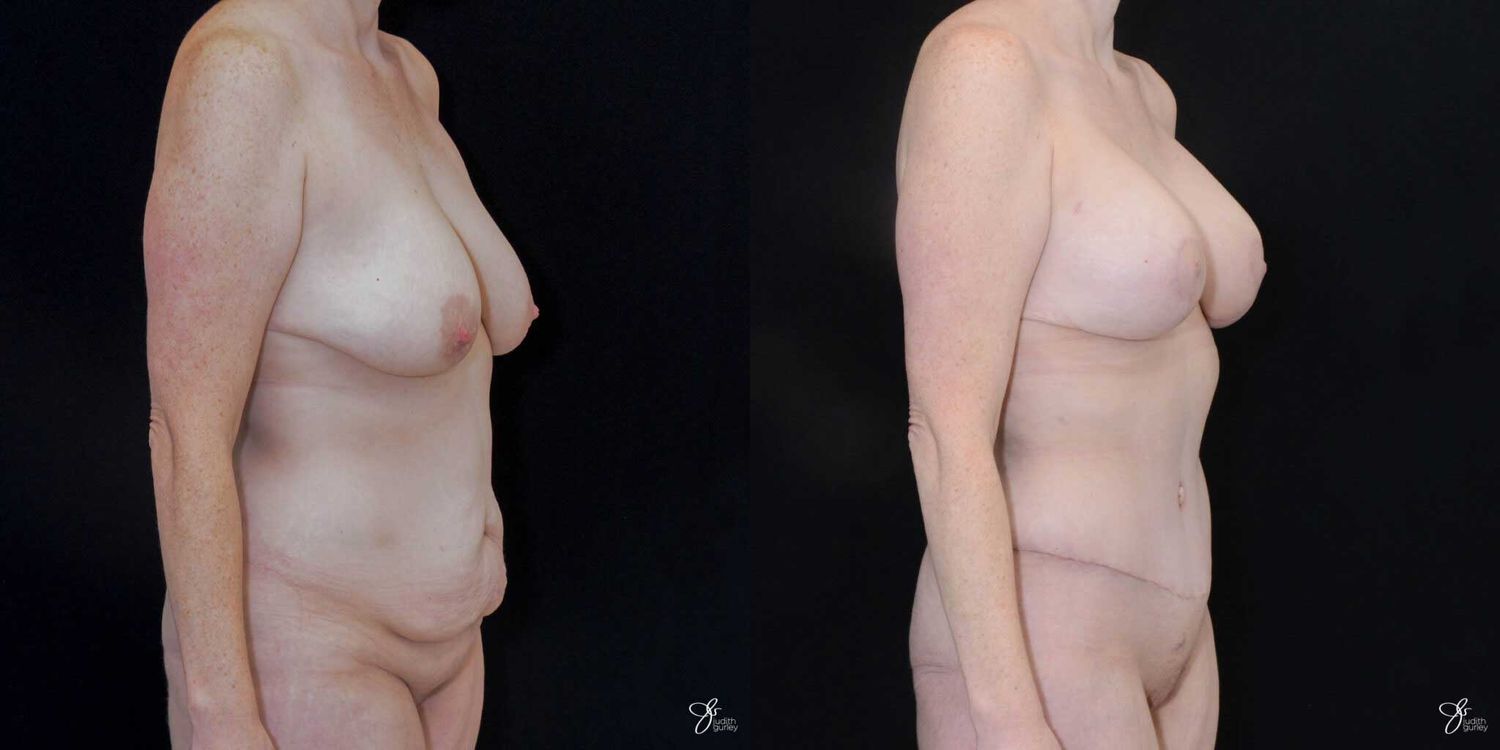 Mommy Makeover Before & After