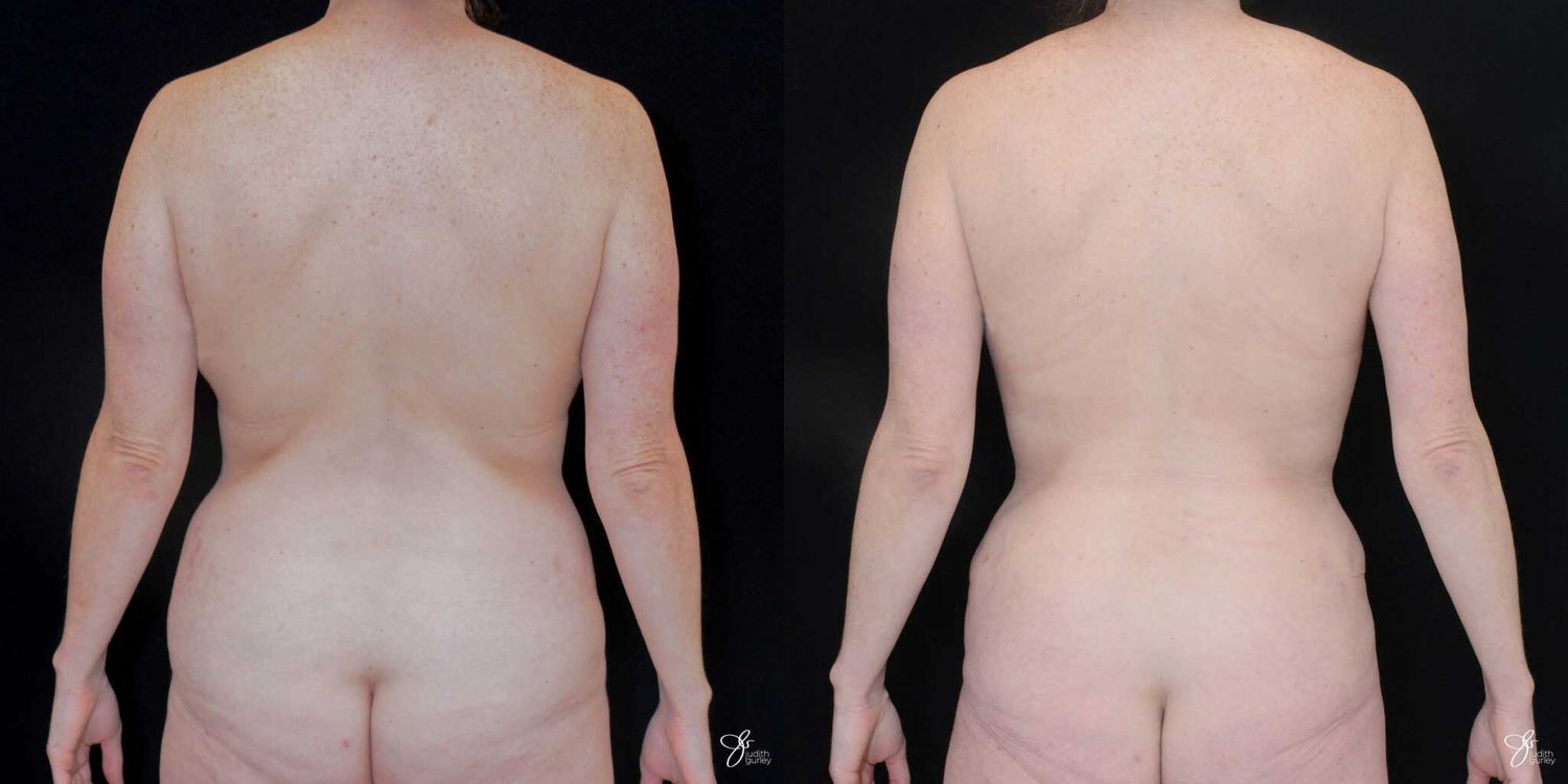 Mommy Makeover Before & After