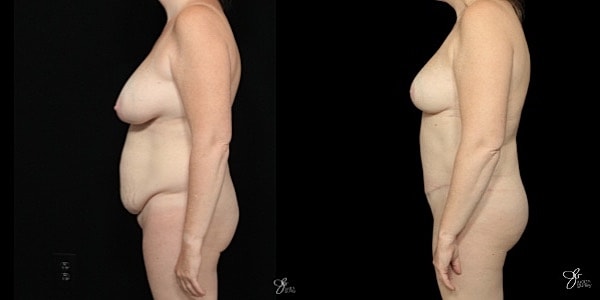 Mommy Makeover Before & After
