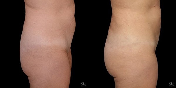 Liposuction Before & After