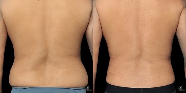 Liposuction Before & After