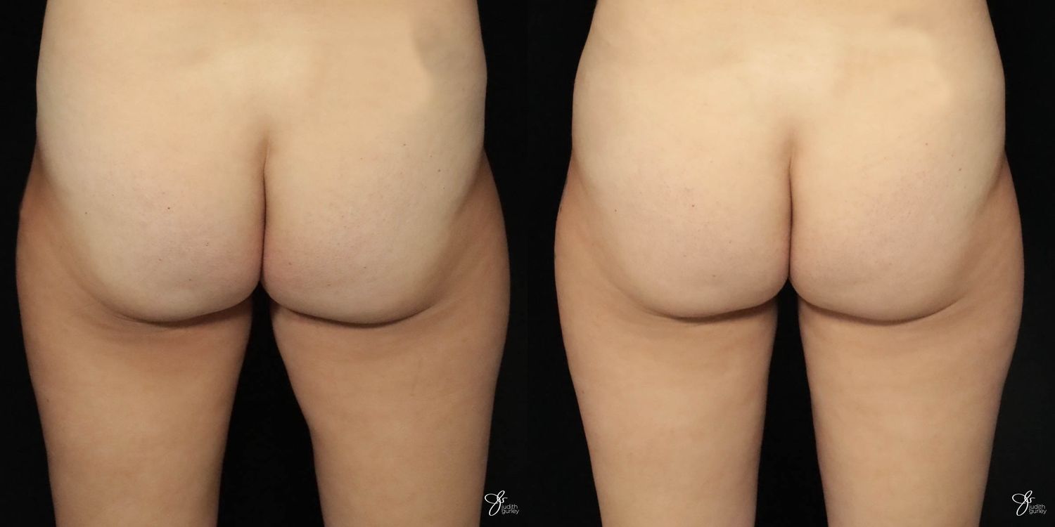 Liposuction Before & After