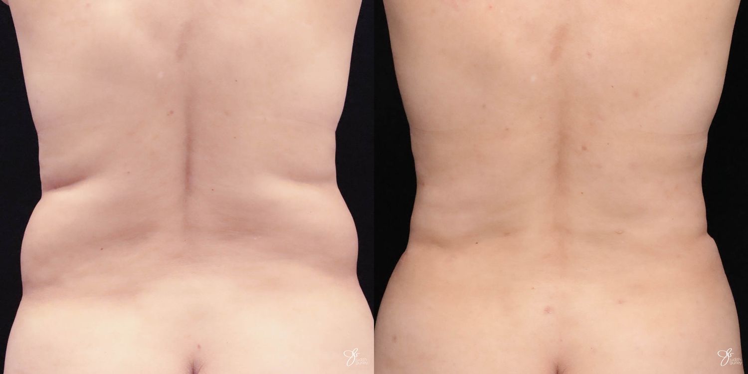 Liposuction Before & After